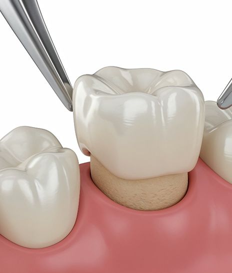 Dental crown fitting over a regular tooth in a mouth mold
