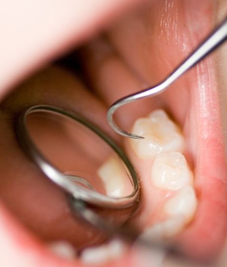 Closeup of someone’s baby teeth being examined