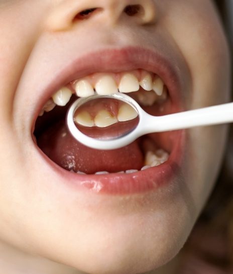 Close up of dental mirror inside of mouth of child