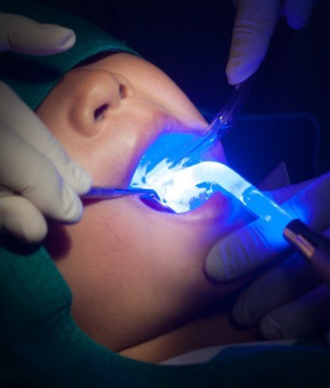 Close up of child receiving dental sealants