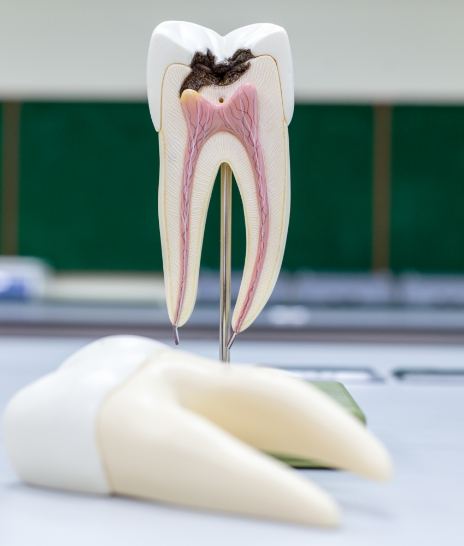 Model of damaged tooth needing pulp therapy