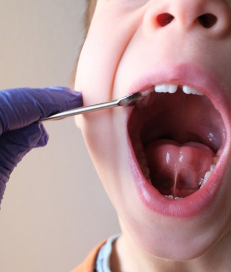 a child opening their mouth to present their frenulum