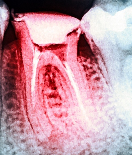 X ray of tooth highlighted red