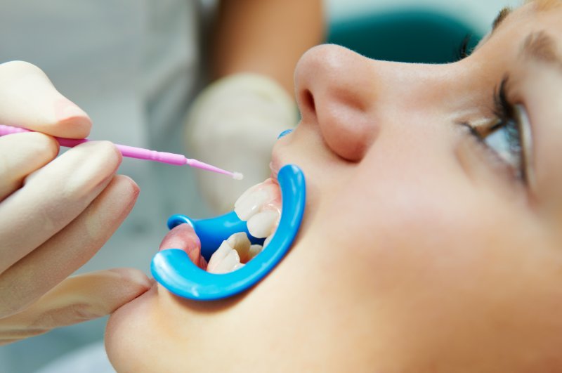 A child receiving dental sealants from their dentist